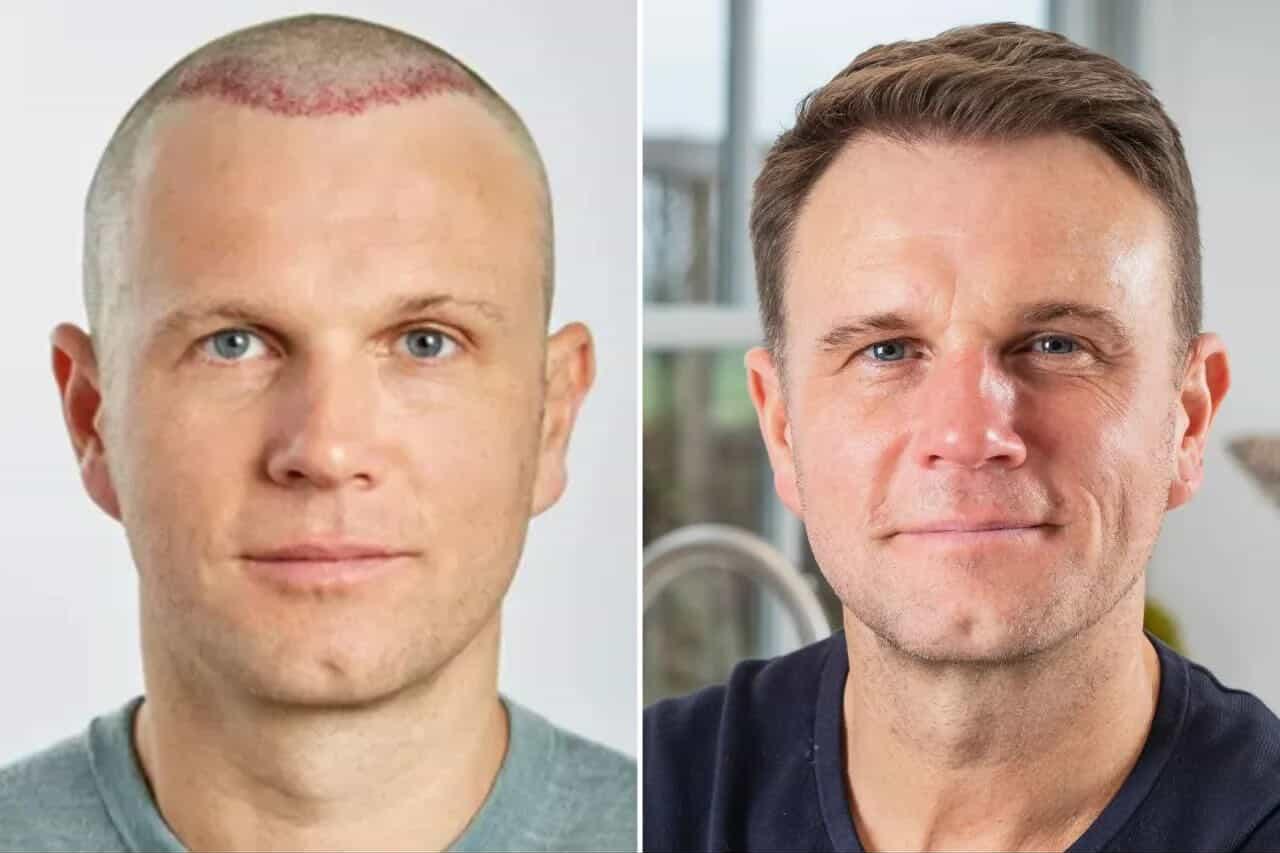 Spencer Stevenson Spex founder sharing hair loss education and hair transplant guidance through SpexHair platform